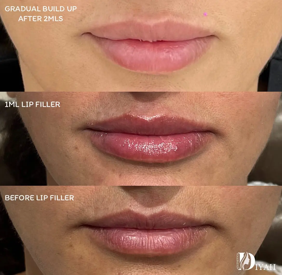 Lip filler progression