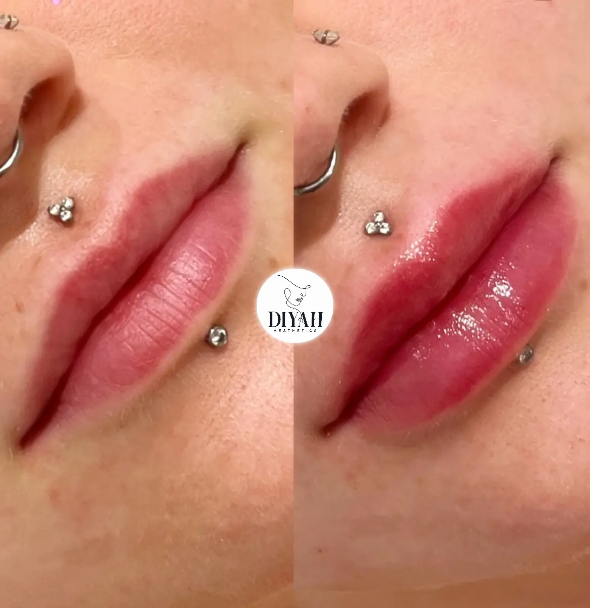 Lip filler before and after