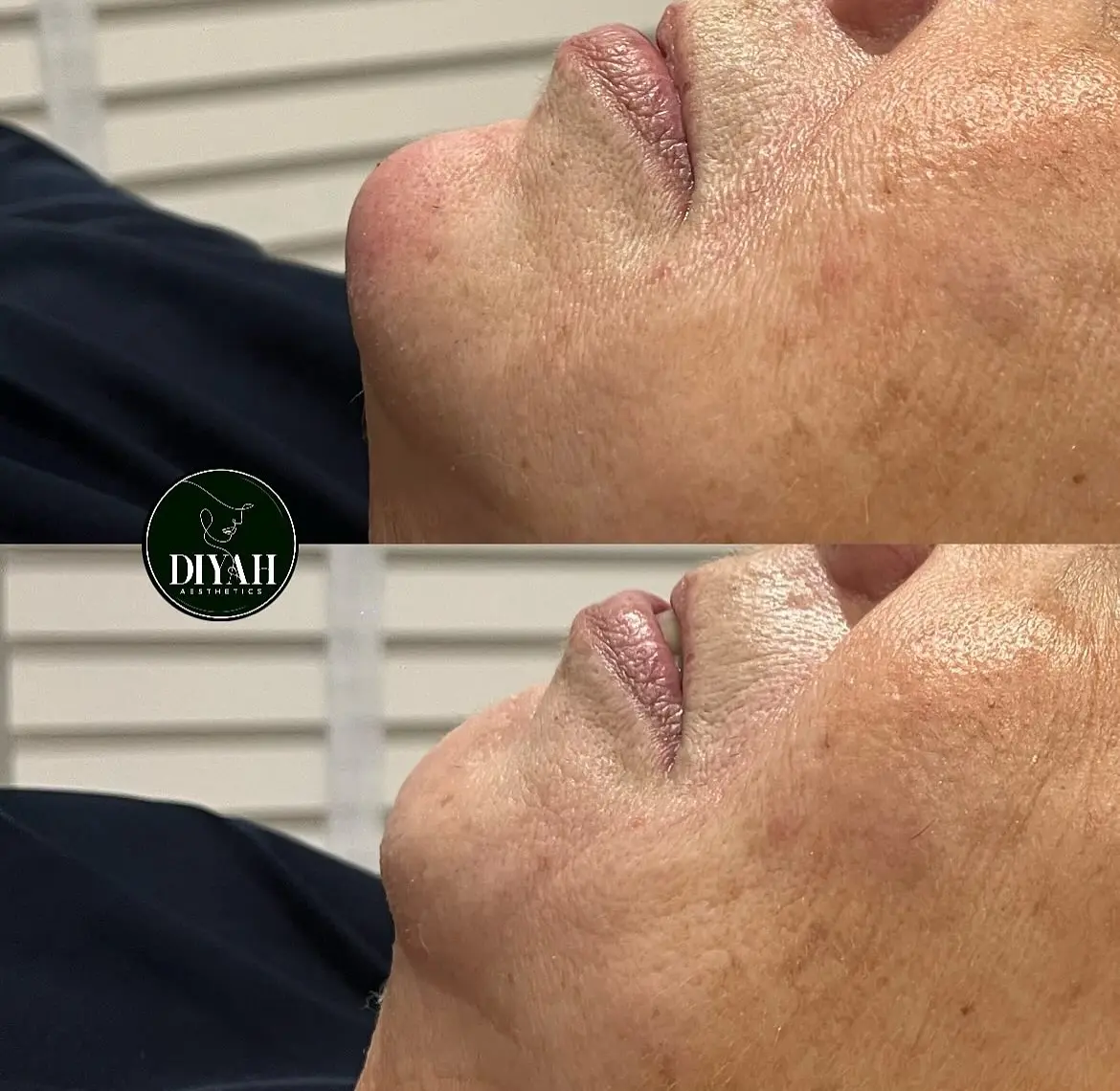Chin filler before and after