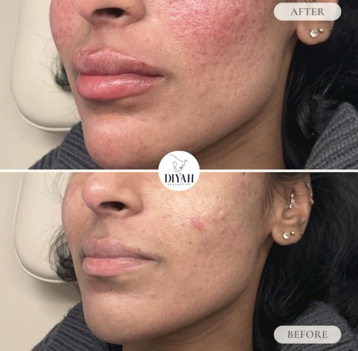Facial balancing filler before and after