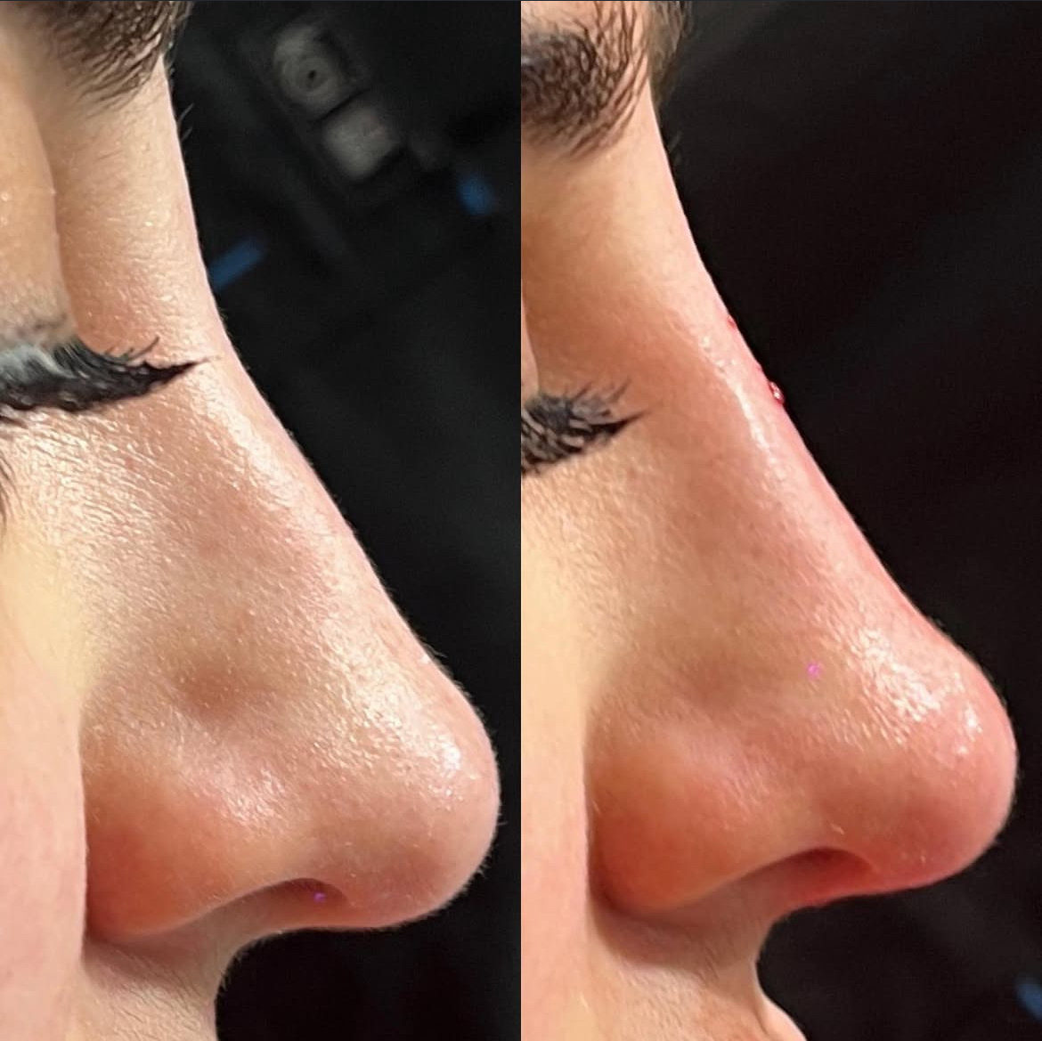 Nasolabial smile line filler before and after