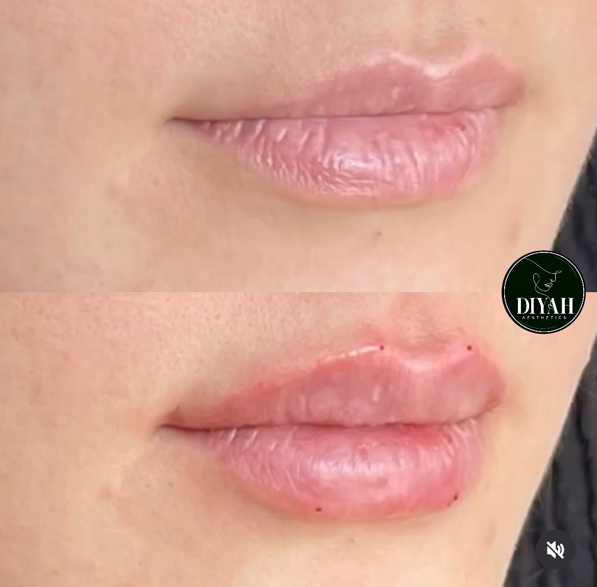 Lip filler before and after