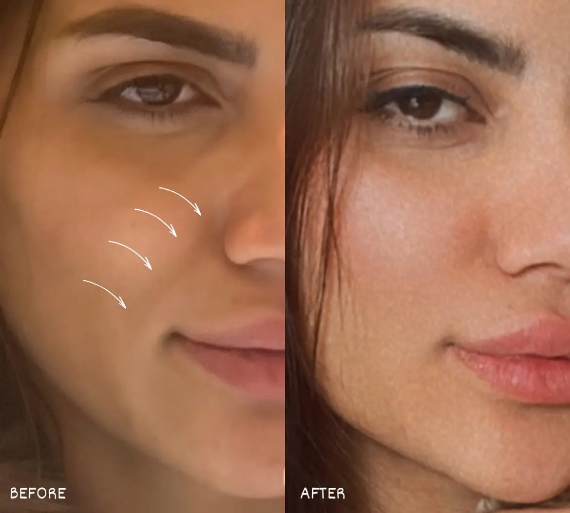 Nasolabial filler before and after